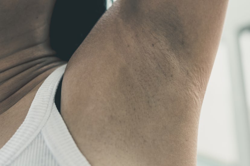 Dirty armpit with smelly underarm problem suffer from hyperhidrosis or excess sweating.