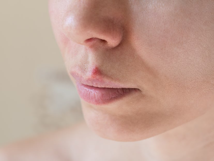 Cold sores. Close-up of the female face, selective focus.