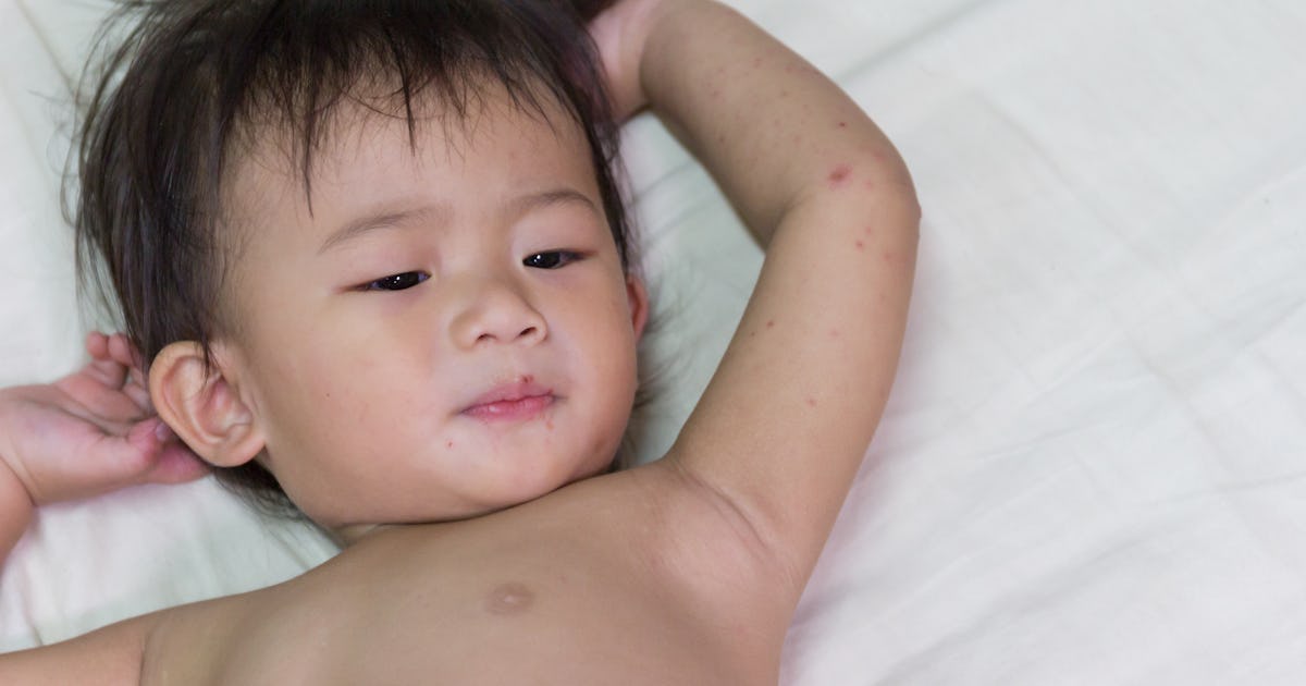 Is Hand Foot Mouth Disease Dangerous For Pregnant Women Here S What You Should Know Is Hand Foot Mouth Disease Dangerous For Pregnant Women Here S What You Should Know