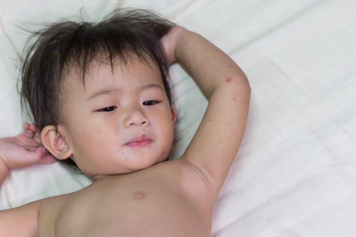 Asian baby infected, hand foot and mouth disease.