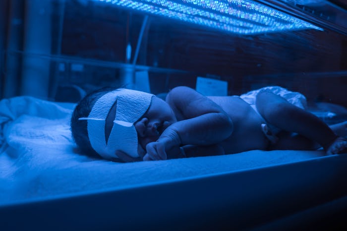Baby has high level of jaundice, and is put in blue light to reduce jaundice level.