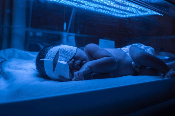 Baby has high level of jaundice, and is put in blue light to reduce jaundice level. 