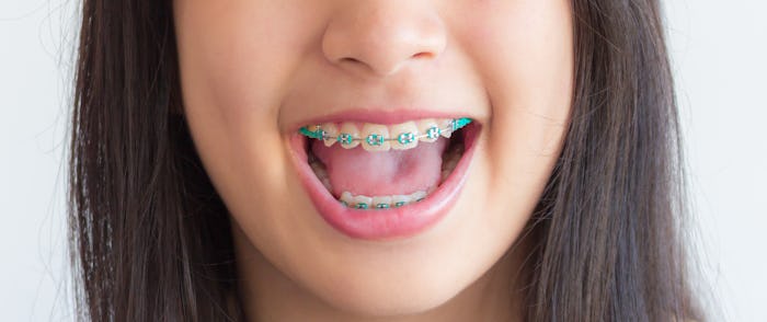 a smile mouth of asian girl and she has green braces 