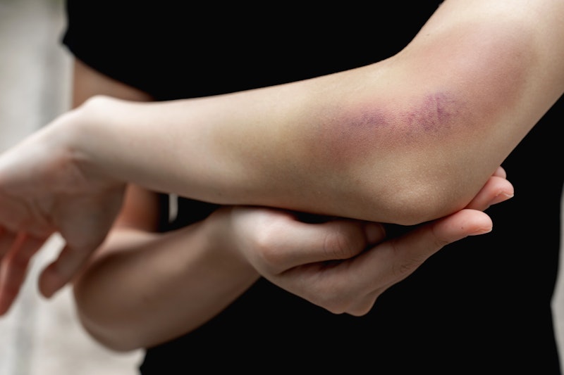 A teenager girl show a big purple bruise on her left arm that is caused by her accidentally fall off...