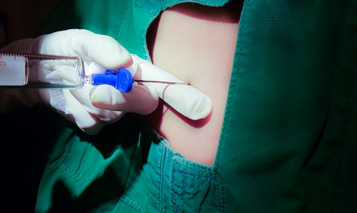 Anesthesiologist or doctor holding epidural needle on back of patient,Spinal anesthesia injections,E...