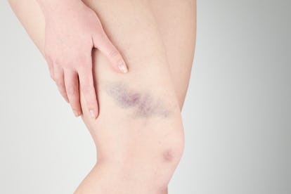 10 Unexpected Signs Bruising Is Part Of A Larger Health Condition