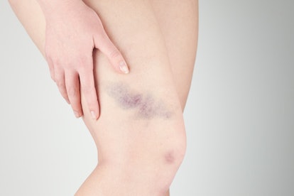 bruises and bruises on the girl's legs