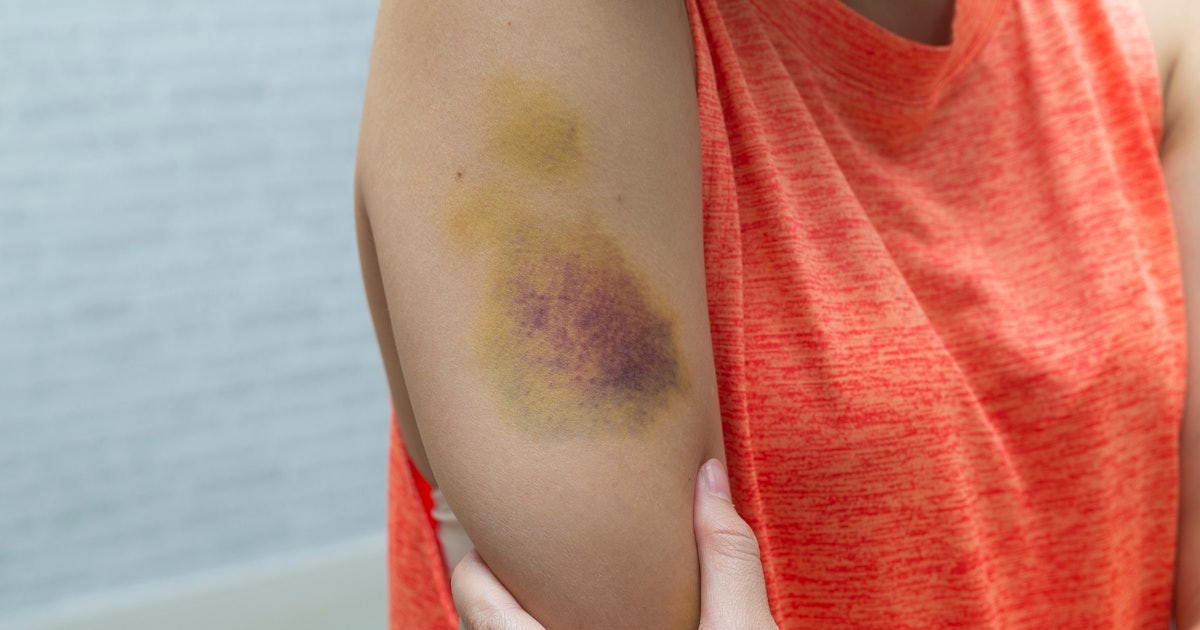 Reason no yellow for bruising Unexplained Bruising: