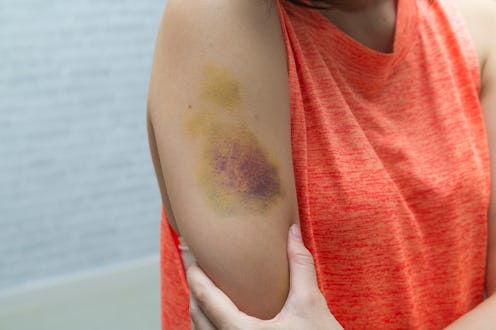 Bruise on woman arm. Injection bruises. Doctor and patient.