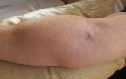 bladre cigaret Milestone 10 Unexpected Signs Bruising Is Part Of A Larger Health Condition