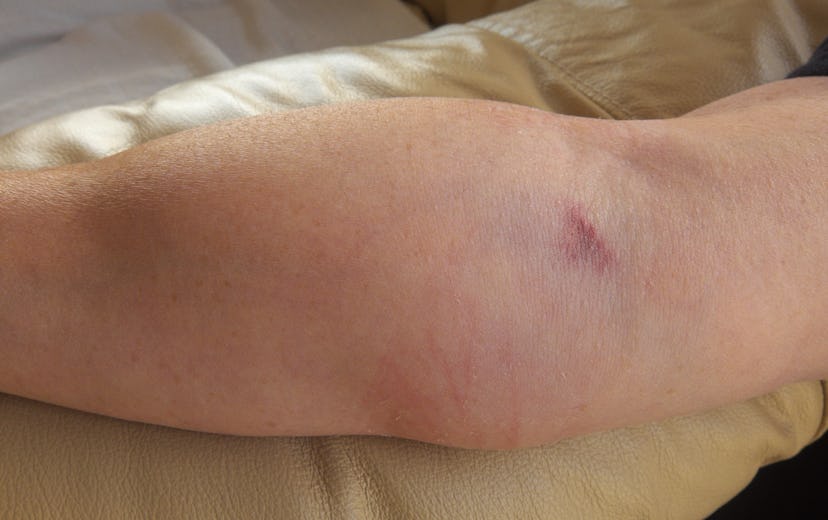 An arm swollen due to medication, administered be a catheter, leaking into the surrounding tissue.