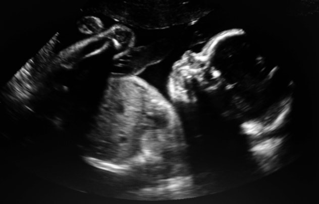 Ultrasound baby in a mother's womb.                             