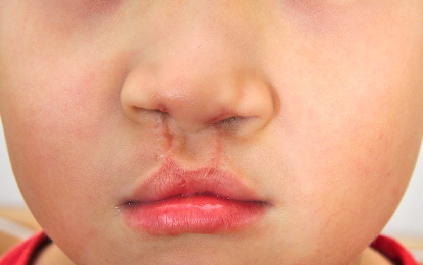 Boy showing a bilateral cleft lip repaired