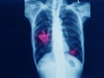 chest x-ray of a patient showing primary lung cancer in both right and left lobe of lung. dark backg...
