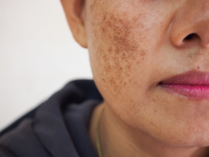 Wrinkles, melasma, dark spots, freckles, and dry skin on a middle age woman face