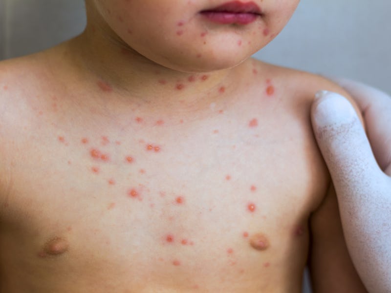 Varicella . Doctor and baby. Viral diseases