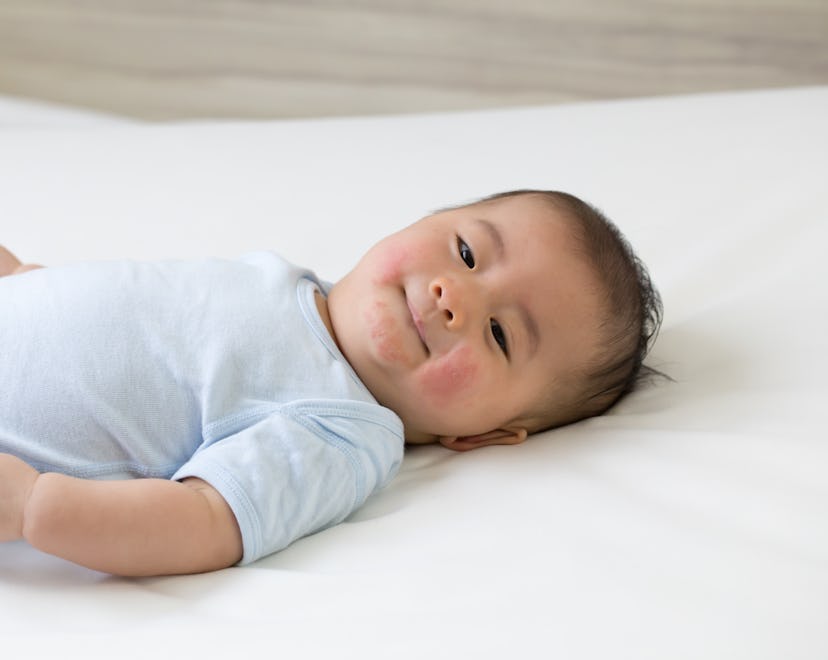 baby boy on bed with rash on cheeks