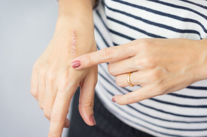 Why do I scar so easily? It could be related to genetics.