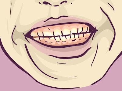 Illustration of Teeth Grinding Symptom of Bruxism