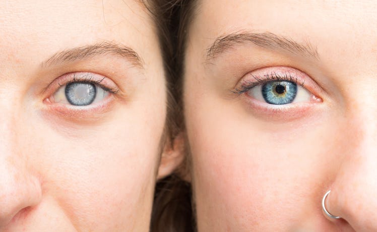 Woman showing eyes before and after cataract removal and corneal cleansing