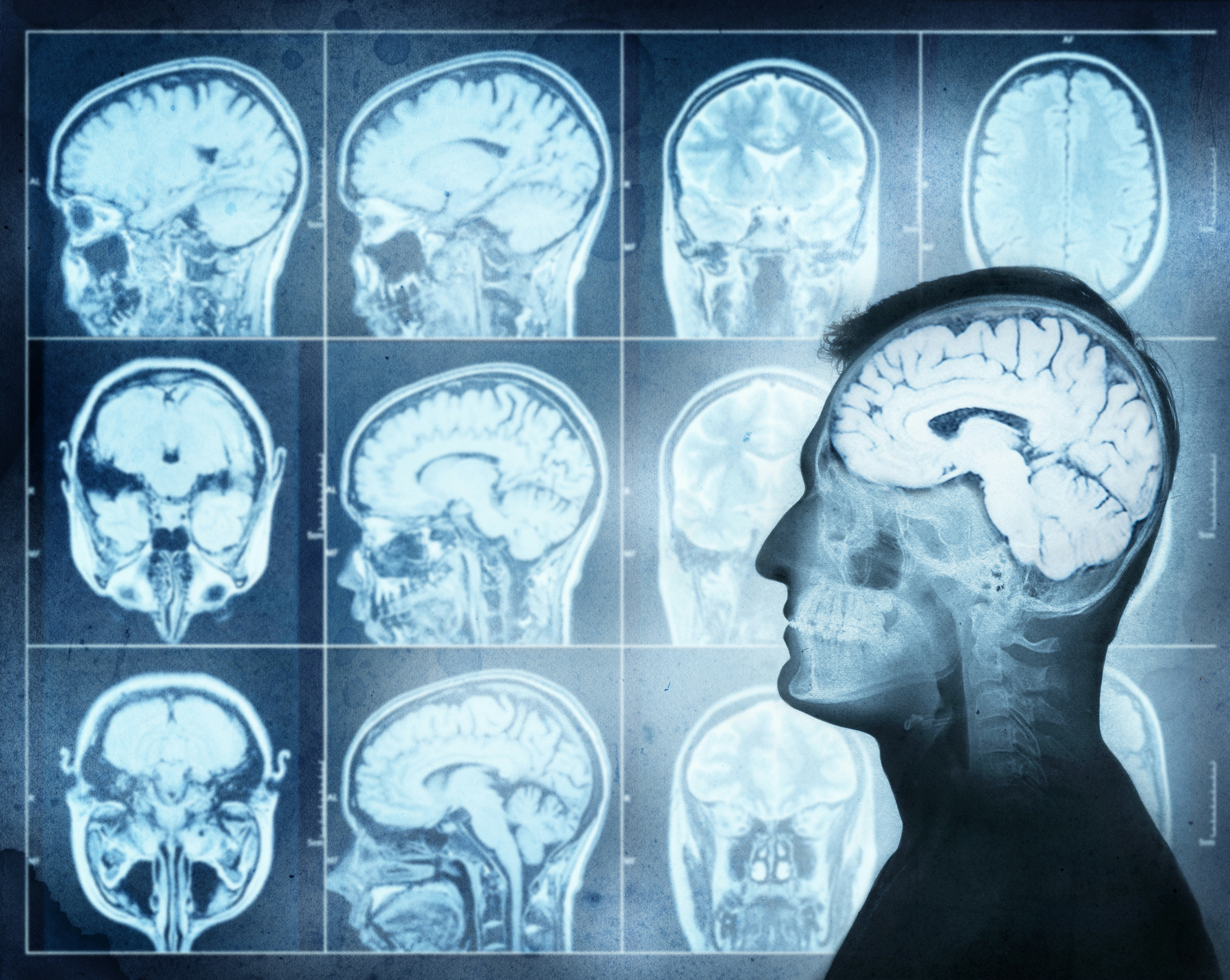 Conceptual image of a man from side profile showing brain  activity. Magnetic resonance image (MRI) of the brain