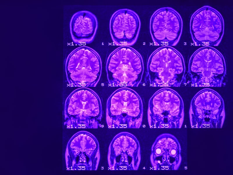 MRI of the brain on a black background with purple  backlight. Left  place for advertising inscripti...