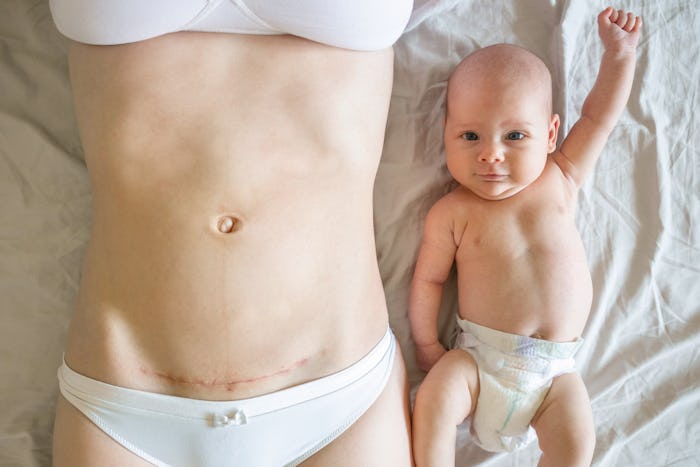 Closeup of woman belly with a scar from a cesarean section and her baby, the best c-section scar rem...