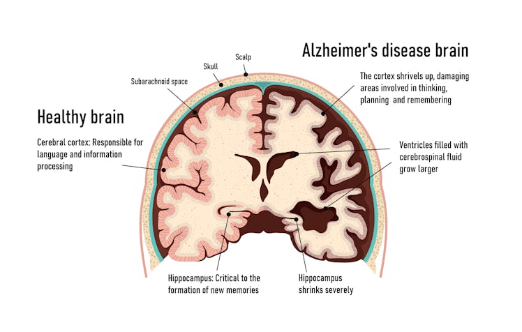 Human brain.  Healthy and brain with Alzheimer's disease