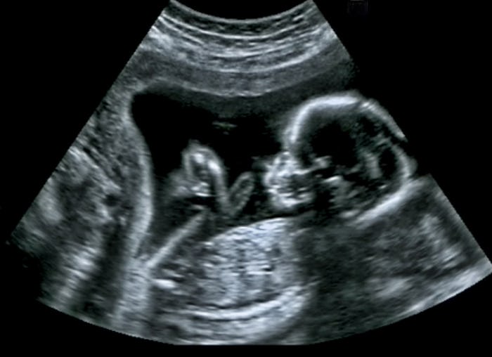 Ultrasound of baby in mother's womb.