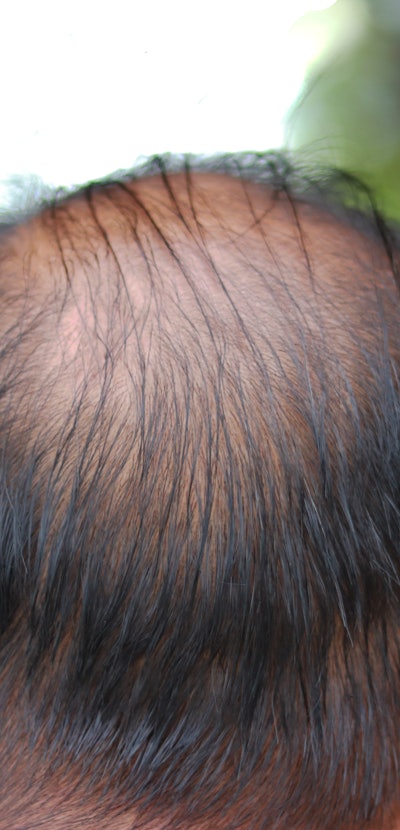 Middle-aged man, bald head With thin hair behind the head Until able to see the scalp Used as an ill...