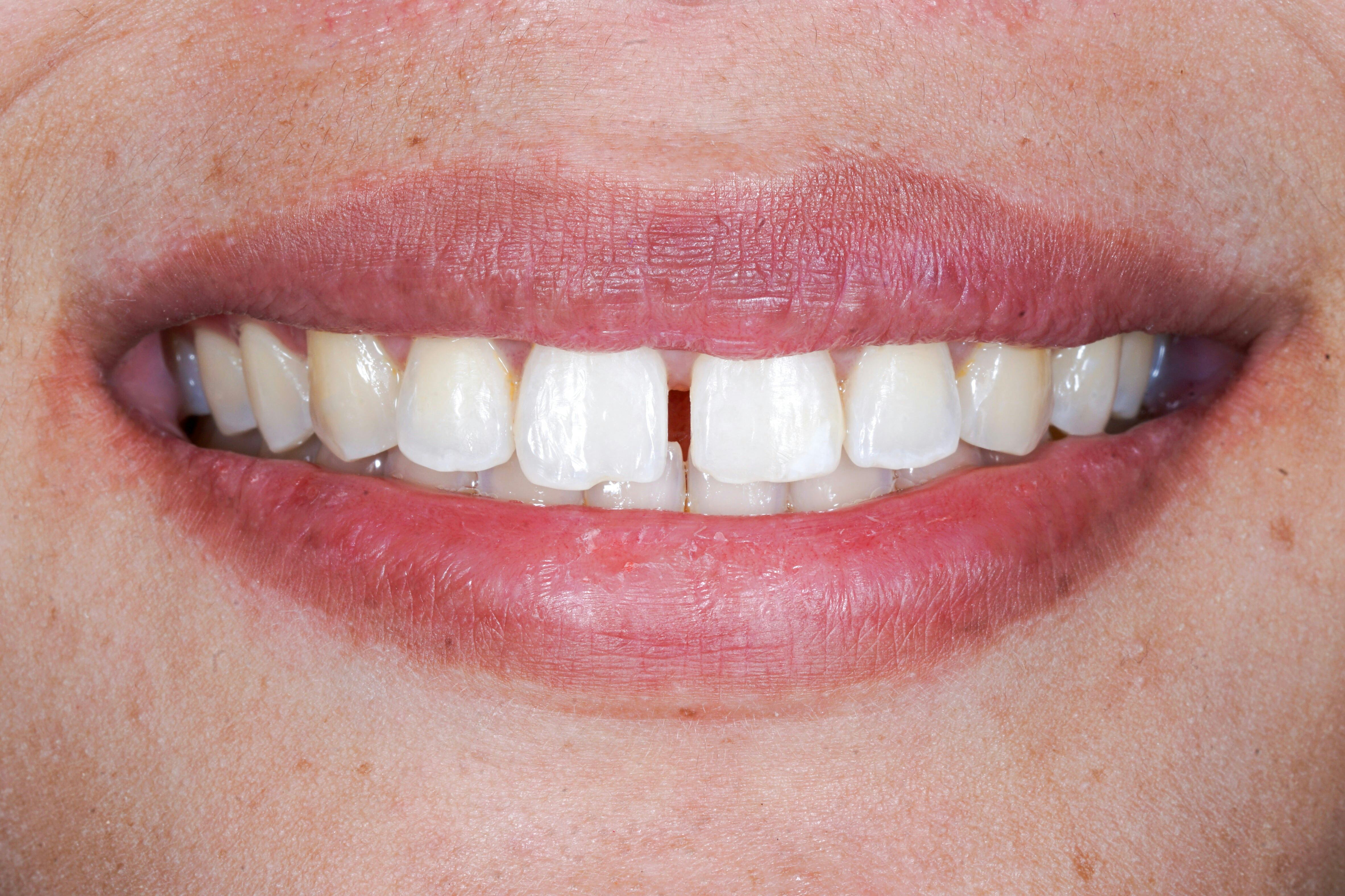 diastema smile show spacing at upper anterior teeth
