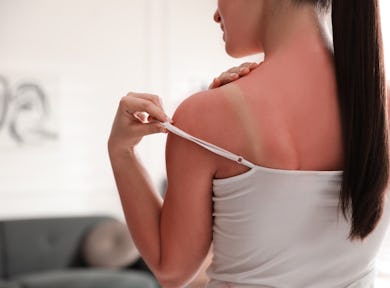 Woman with sunburned skin at home, closeup