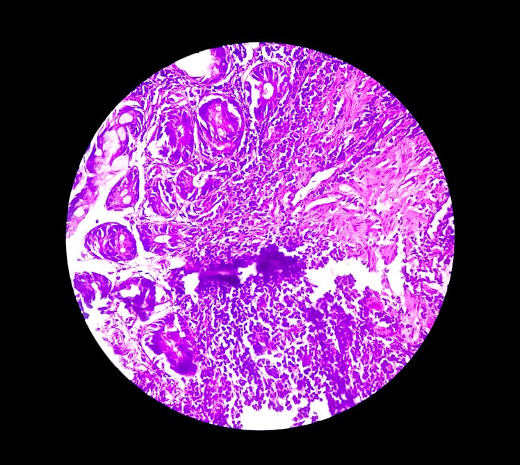 Tissue from terminal ileum: Chronic nonspecific ileitis or inflammation of the ileum, is often cause...