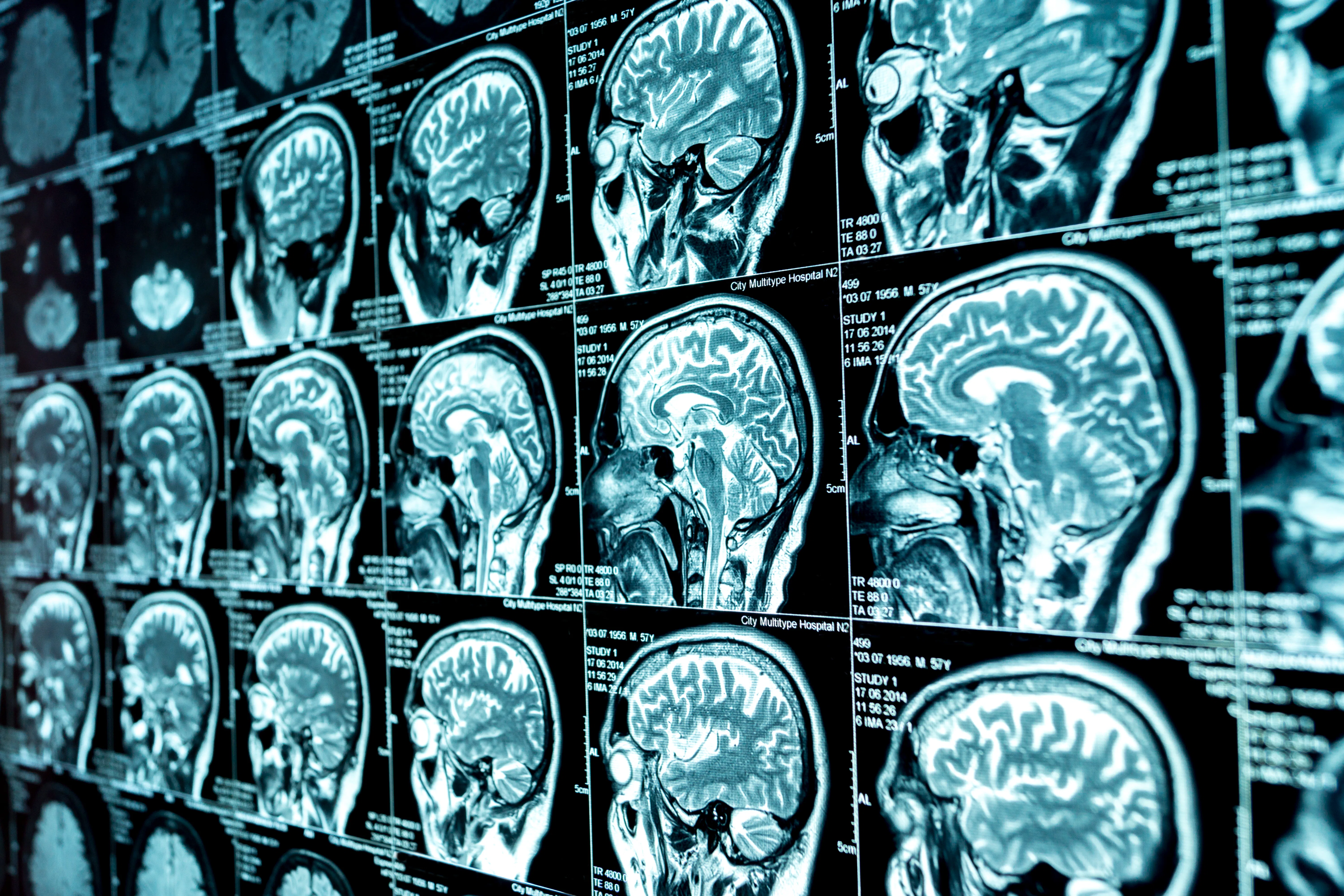 Brains Of Teens Who Lived Through Pandemic Are Aging Faster, Study Says