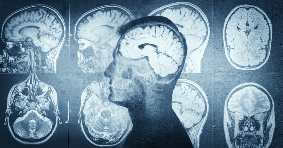 Brain Pattern Imaging Researchers find similar brain pattern shifts in two common conditions