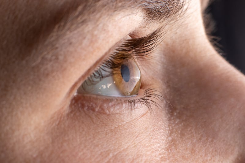 Macro eye photo. Keratoconus - eye disease, thinning of the cornea in the form of a cone. The cornea...