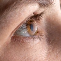 Macro eye photo. Keratoconus - eye disease, thinning of the cornea in the form of a cone. The cornea...
