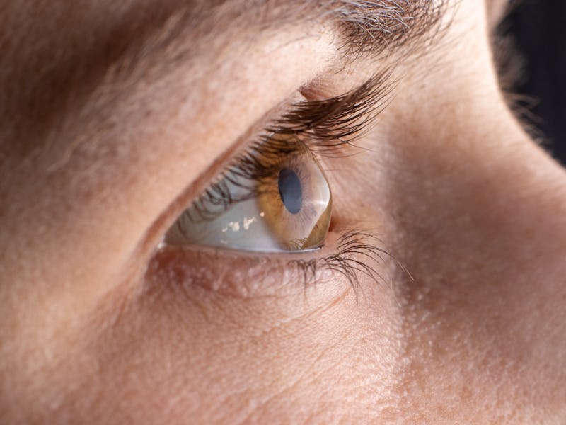 Macro eye photo. Keratoconus - eye disease, thinning of the cornea in the form of a cone. The cornea...