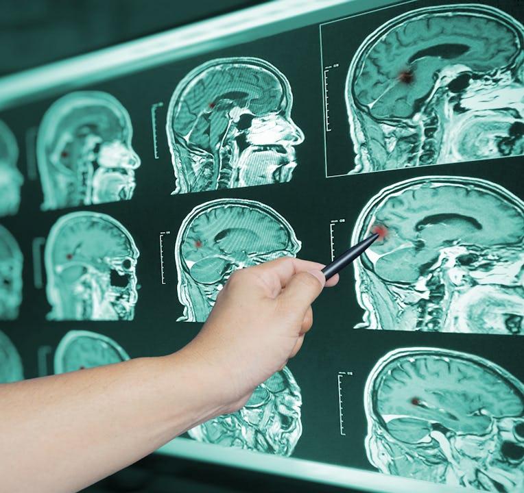 Close up Hand doctor point brian scan image of a recent traumatic brain injury patient showing brain...