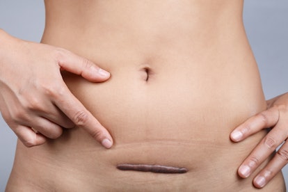 A thick, raised keloid c-section scar can develop on the abdomen across the incision site. 