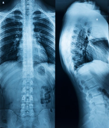 X-ray of the spine of a man with a stoop in two projections in full view and profile
