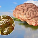 Brain-eating amoeba infection, naegleriasis. Trophozoite form of the parasite Naegleria fowleri and ...