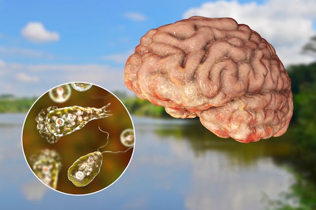 Brain-eating amoeba infection, naegleriasis. Trophozoite form of the parasite Naegleria fowleri and ...