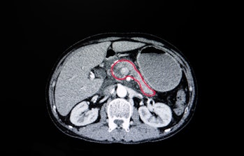 A CT scan of the pancreas, which the AI could use to diagnose cancer.