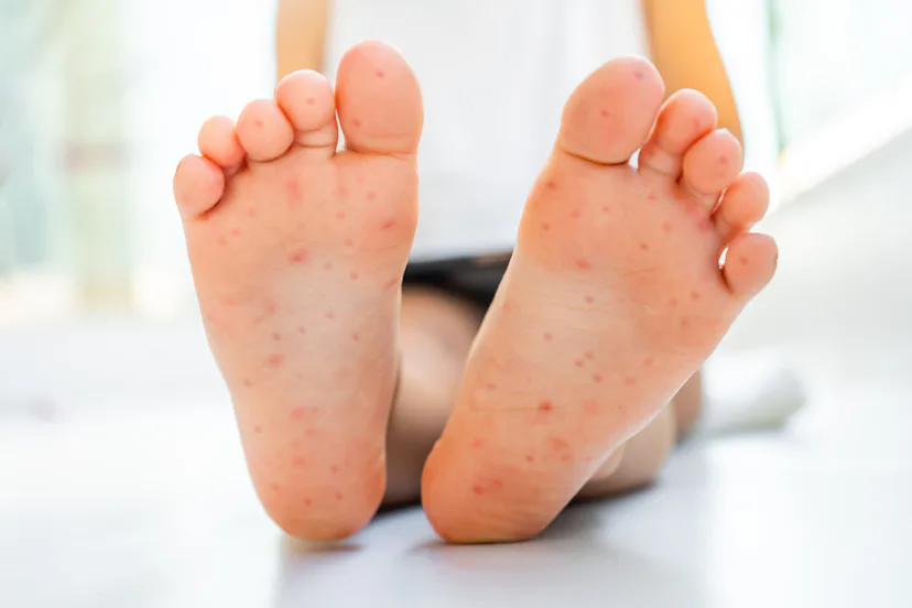 Amoxicillin Rash: Is It Really An Allergy? Doctors Explain
