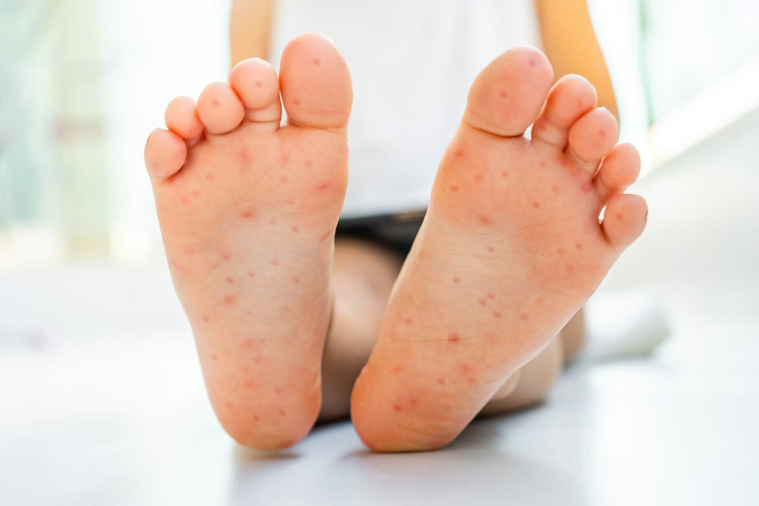 Amoxicillin Rash: Is It Really An Allergy? Doctors Explain