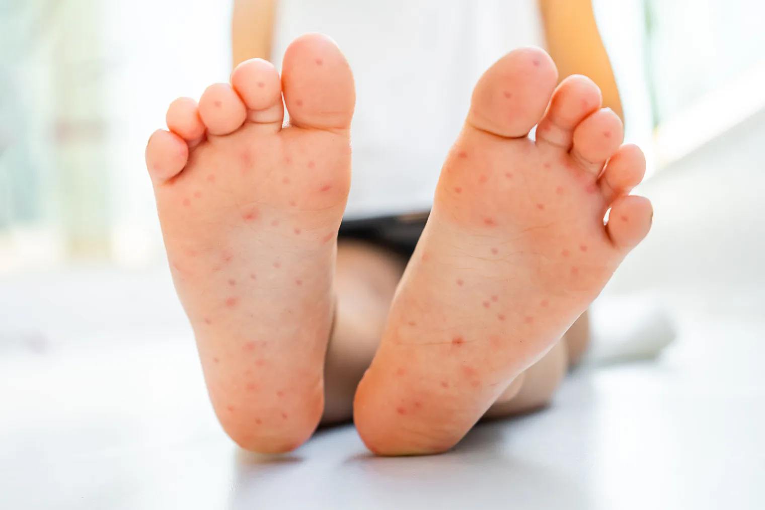 Amoxicillin Rash Is It Really An Allergy Doctors Explain Amoxicillin rash is it really an allergy doctors explain