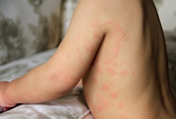 The skin of an allergic child or hives is a rash. viral hives