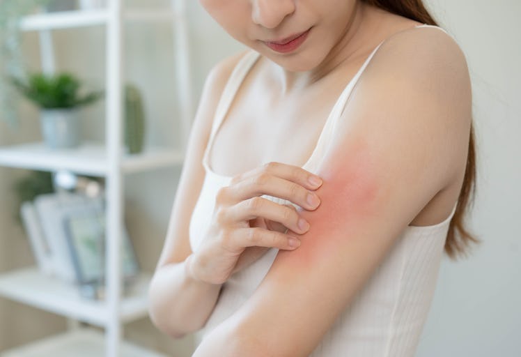 Dermatology, asian young woman, girl allergy, allergic reaction from atopic, insect bites on her arm...