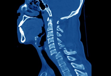 sagittal computer tomography image of cervical spine showing bilateral facet joint dislocation and f...